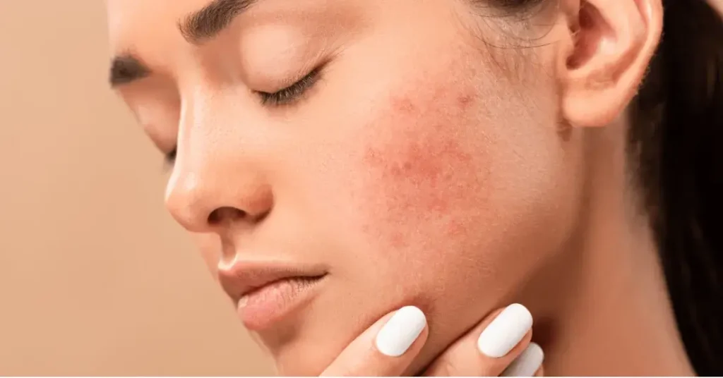 Acne disease and its Treatment