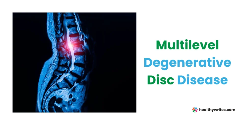 Multilevel Degenerative Disc Disease